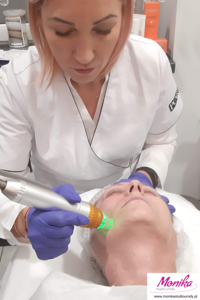 radiofrekwencja mikroigłowa frakcyjna Zabrze Studio Urody Monika
