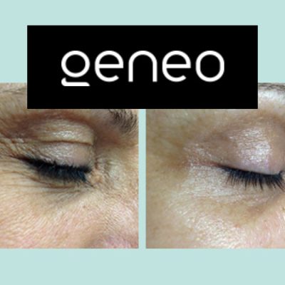 zabieg-geneo-gabinet-kosmetyczny-zabrze Zabieg geneo w gabinecie kosmetycznym w zabrzu